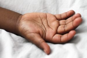 脂肪吸引で皮膚が硬くなる理由とは何か？